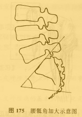 慢性下腰部疼痛 由于腰骶角的加大(图175),腰部负重力线由前部的椎体